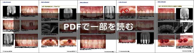 Root Membrane Technique のすべて